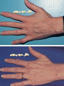 اسکلروتراپی