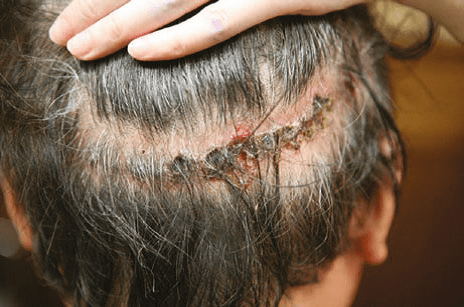 Necrosis and effluvium-