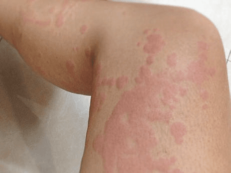 hair transplant urticaria